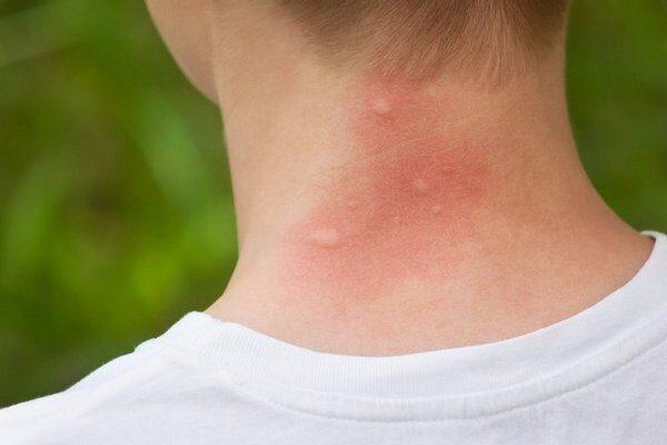 muỗi đốt để lại chấm đỏ