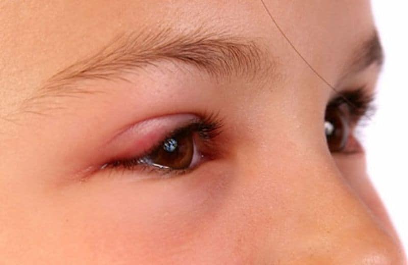 trẻ bị côn trùng đốt sưng mắt
